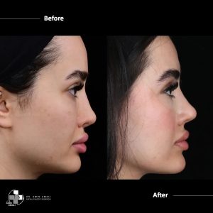 قبل و بعد من عملية ترميم الأنف