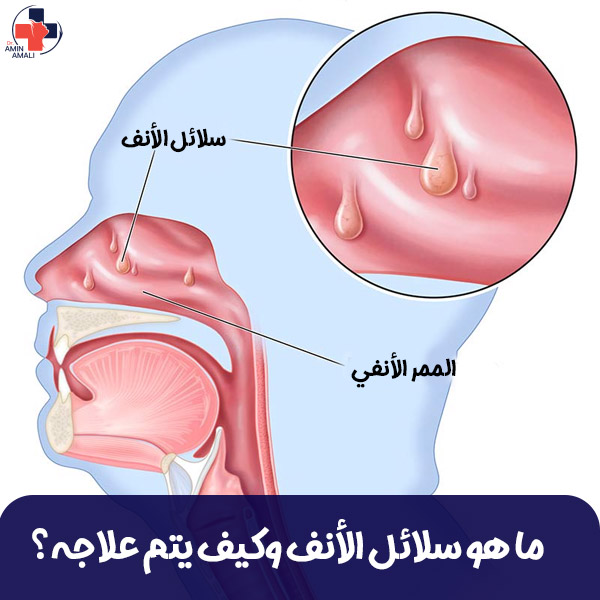 سلائل الأنف